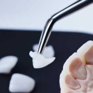 faccette dentali morena